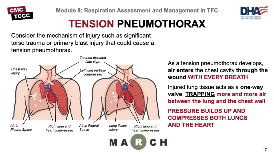 tracheal deviation tension pneumothorax