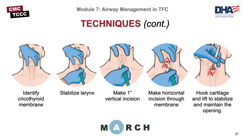 Emergency Airway Management 裁断済み Clinical Skills - Airway management Step-wise - YouTube