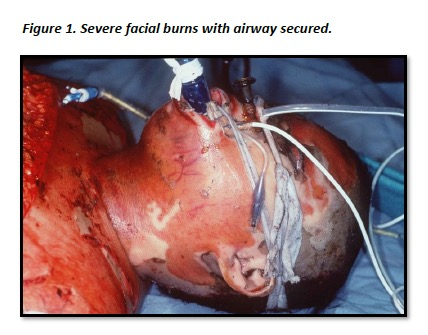 Unpacking the Fundamentals of Burn Wounds