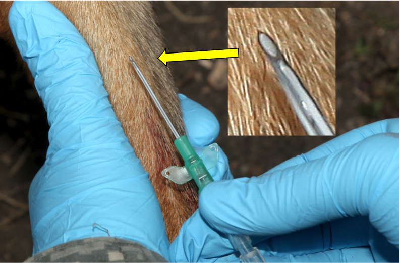 Figure 25.  Pierce the skin with the catheter