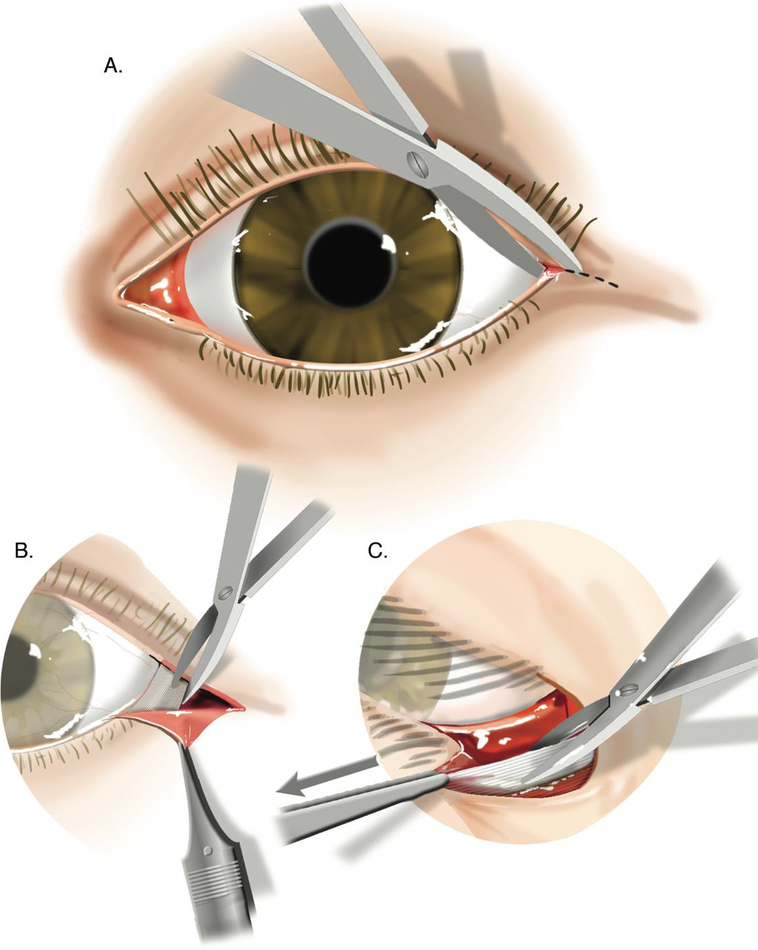 Eye Trauma: Initial Care