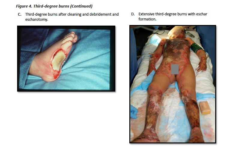 Burn Wound Management Under Prolonged Field Care