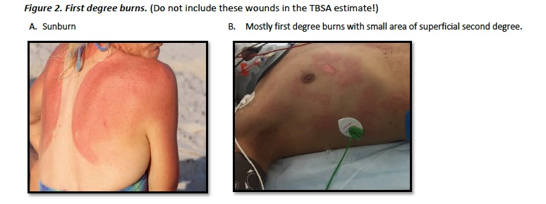Unpacking the Fundamentals of Burn Wounds