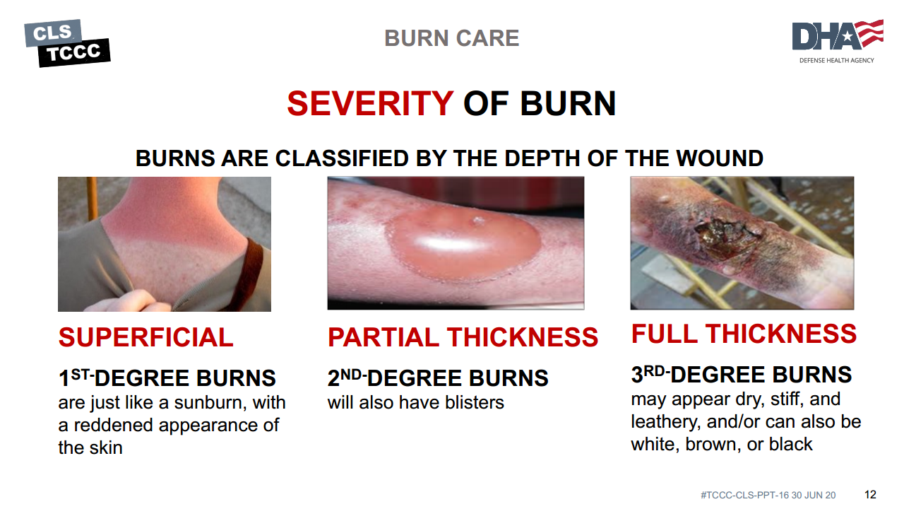 Unpacking the Fundamentals of Burn Wounds